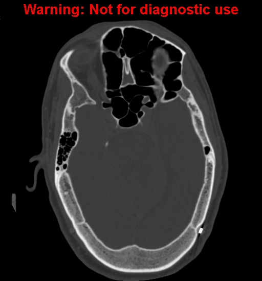 Calvarial thickening from chronic shunting (Radiopaedia 60079-67637 Axial bone window 65).jpg