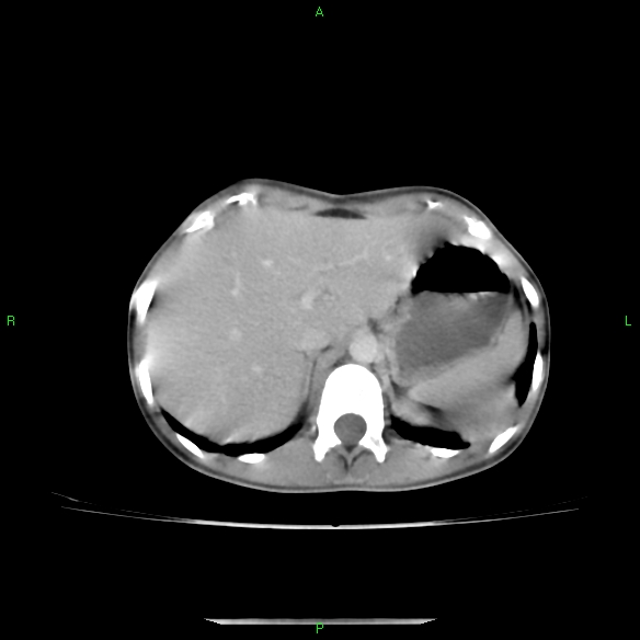 File:Cannon ball metastases - synovial sarcoma (Radiopaedia 26135-26271 C 35).jpg