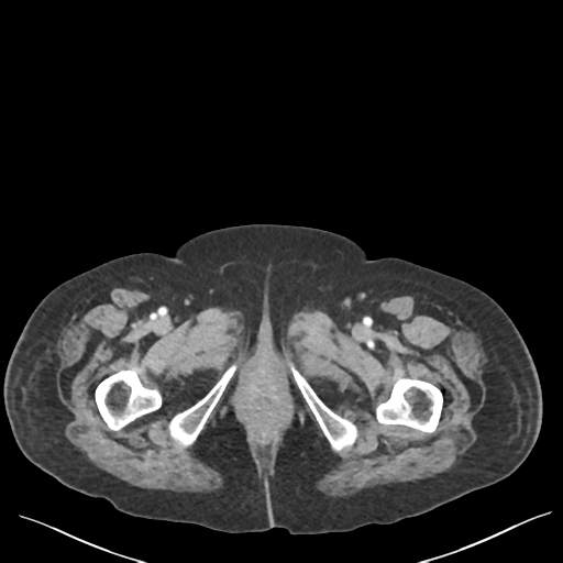 Cannonball metastases from endometrial cancer (Radiopaedia 42003-45031 E 82).png