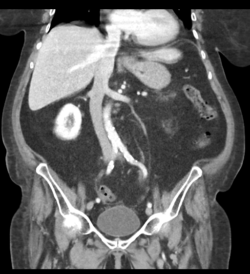 Cannonball metastases from endometrial cancer (Radiopaedia 42003-45031 F 36).png