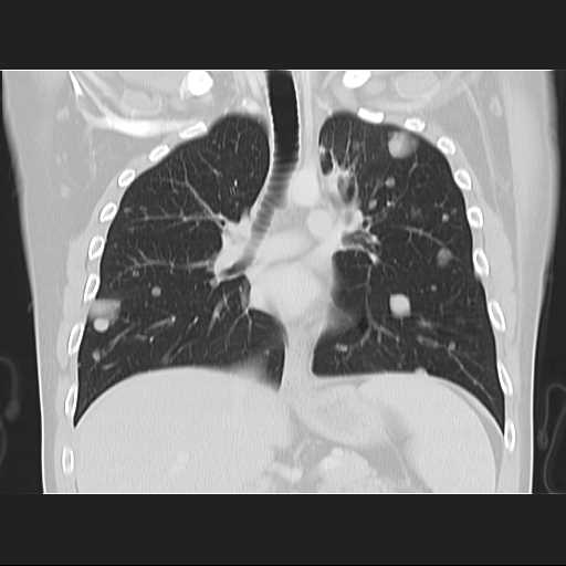 File:Cannonball pulmonary metastases (Radiopaedia 67684-77101 C 12).jpg