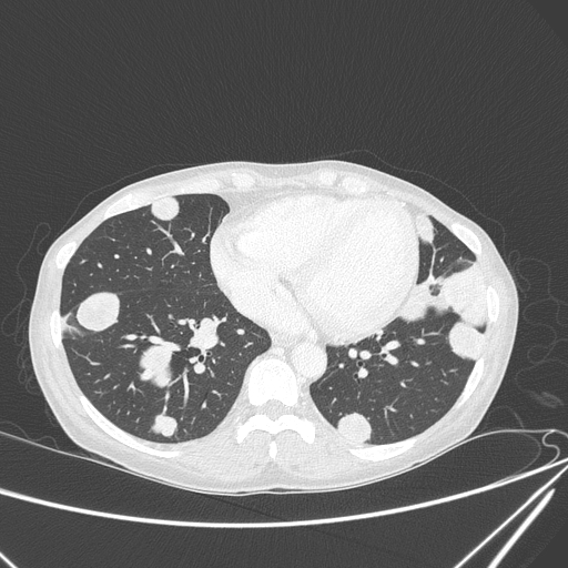 Canonball lung metastasis (Radiopaedia 77634-89837 Axial lung window 124).jpg