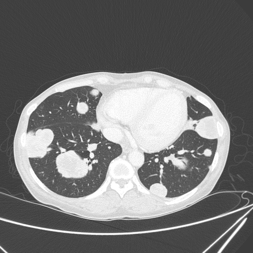 Canonball lung metastasis (Radiopaedia 77634-89837 Axial lung window 129).jpg