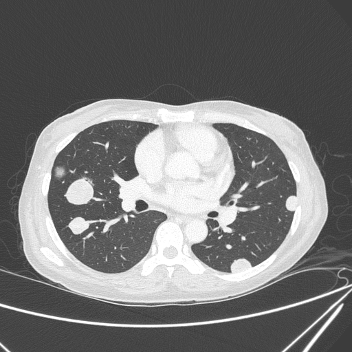 File:Canonball lung metastasis (Radiopaedia 77634-89837 Axial lung window 91).jpg