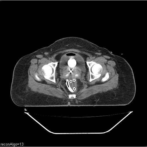 File:Carcinoma cervix- brachytherapy applicator (Radiopaedia 33135-34173 Axial non-contrast 33).jpg