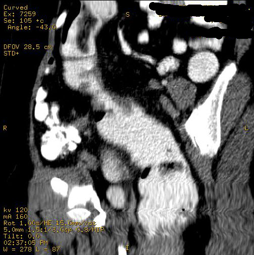 File:Carcinoma of sigmoid colon (Radiopaedia 23071-23100 D 4).jpg