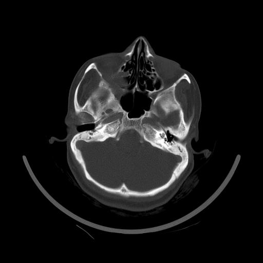 Carcinoma of the maxillary antrum (Radiopaedia 53805-59888 Axial bone window 35).jpg