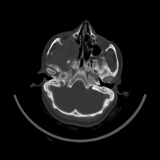 Carcinoma of the maxillary antrum (Radiopaedia 53805-59888 Axial bone window 41).jpg