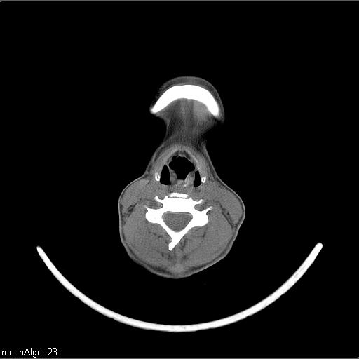 Carcinoma of the maxillary antrum (Radiopaedia 53805-59888 Axial non-contrast 29).jpg