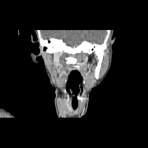 File:Carcinoma of the maxillary antrum (Radiopaedia 53805-59888 Coronal C+ delayed 93).jpg