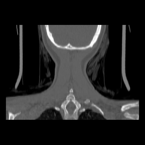 Carcinoma of the maxillary antrum (Radiopaedia 53805-59888 Coronal bone window 138).jpg