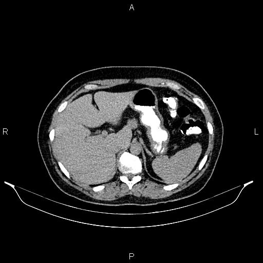 File:Carcinoma of uterine cervix (Radiopaedia 85861-101700 Axial C+ delayed 7).jpg