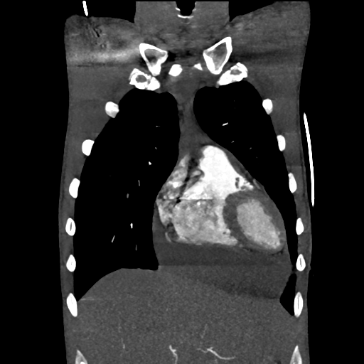 Cardiac tumor - undifferentiated pleomorphic sarcoma (Radiopaedia 45844-50134 Coronal non-contrast 16).png