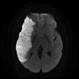 File:Carotid arterial dissection with acute cerebral infarction (Radiopaedia 26636-26784 Axial DWI 11).jpg