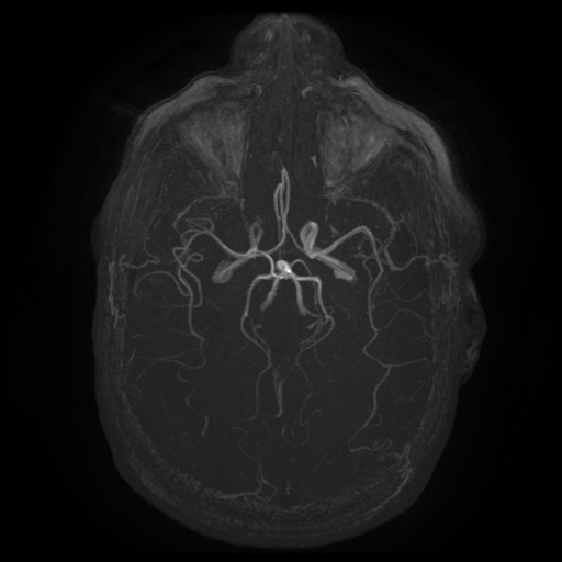 Carotid arterial dissection with acute cerebral infarction (Radiopaedia 26636-26784 MRA 1).jpg