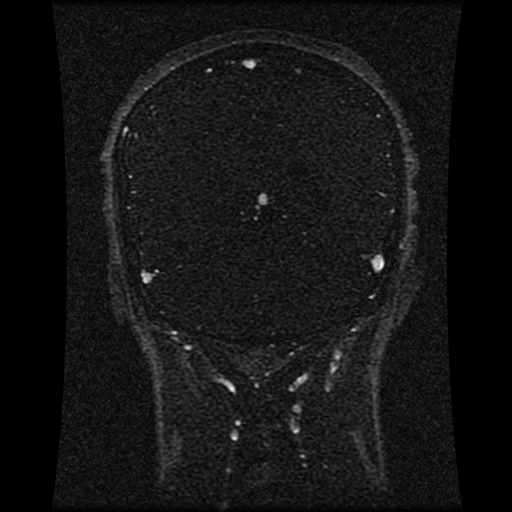 Carotid arterial dissection with acute cerebral infarction (Radiopaedia 26636-26784 MRV 69).jpg