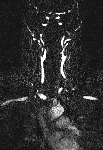 Carotid artery dissection (Radiopaedia 28441-28689 Coronal MRA 38).jpg