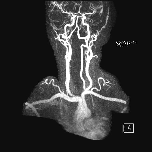 File:Carotid artery dissection (Radiopaedia 28441-28689 MIP Carotids MRA 9).jpg