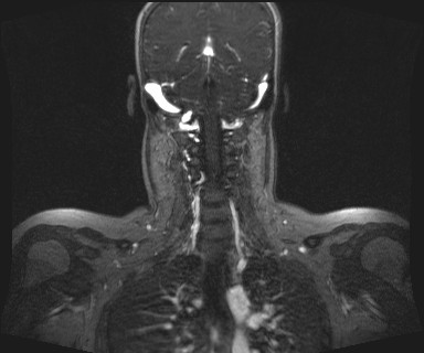 Carotid body tumor (Radiopaedia 12777-12912 MRA 49).jpg