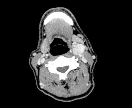 Carotid body tumor (Radiopaedia 61750-69757 Axial Post contrast 51).jpg
