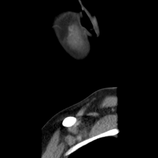 File:Carotid body tumor (paraganglioma) (Radiopaedia 38586-40729 C 4).jpg