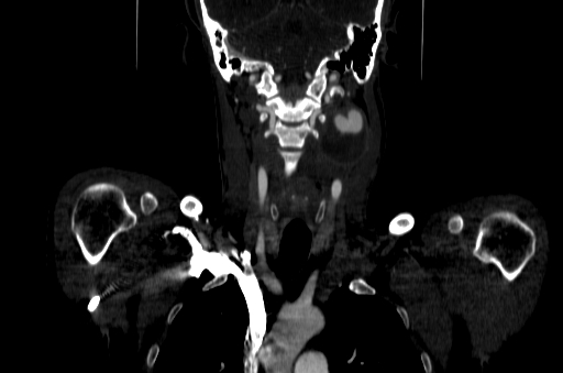 File:Carotid bulb pseudoaneurysm (Radiopaedia 57670-64616 D 37).jpg