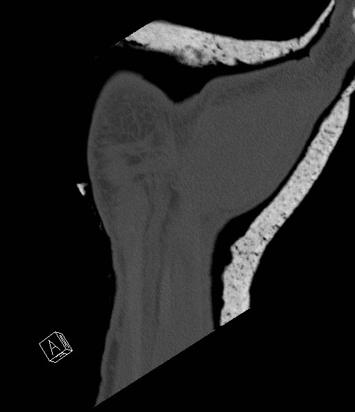 File:Carpal fractures (smart watch impaction) (Radiopaedia 55844-62430 Coronal bone window 27).jpg