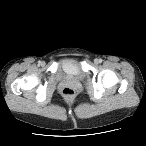 Castleman disease with fibrous pseudotumor in the abdomen (Radiopaedia 77296-89373 A 126).jpg