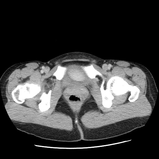 File:Castleman disease with fibrous pseudotumor in the abdomen (Radiopaedia 77296-89373 A 127).jpg