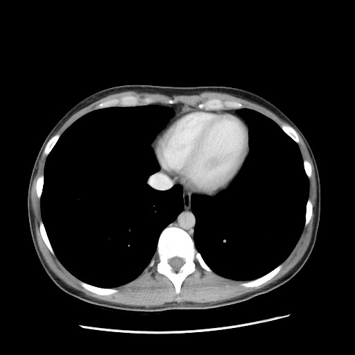 File:Castleman disease with fibrous pseudotumor in the abdomen (Radiopaedia 77296-89373 Axial 129).jpg