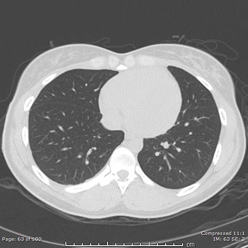 File:Catamenial pneumothorax (Radiopaedia 54382-60600 Axial non-contrast 63).jpg
