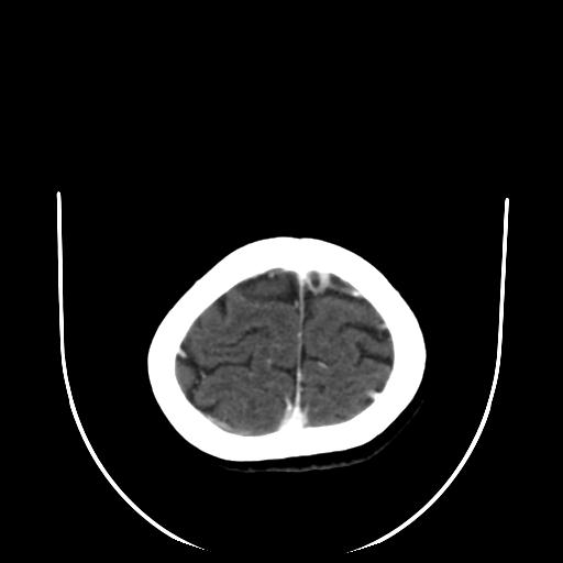 File:Cavernoma with developmental venous anomaly (Radiopaedia 22470-22506 C+ arterial phase 31).jpg