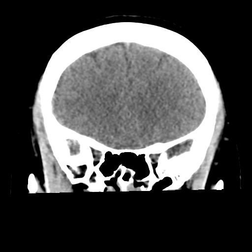 Cavernoma with hemorrhage (Radiopaedia 70755-80931 Coronal non-contrast 20).png
