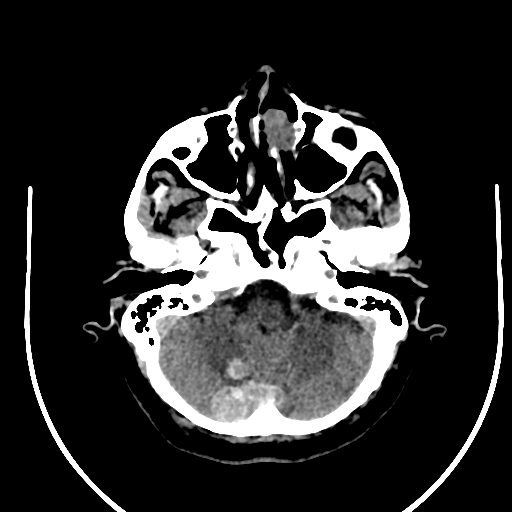 Cavernous hemangioma of the cerebellar falx (Radiopaedia 73025-83723 Axial non-contrast 25).jpg