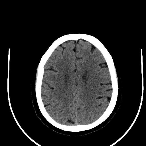 Cavernous hemangioma of the cerebellar falx (Radiopaedia 73025-83723 Axial non-contrast 96).jpg