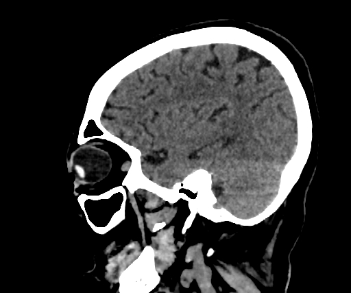 Cavernous hemangioma of the cerebellar falx (Radiopaedia 73025-83723 B 240).jpg