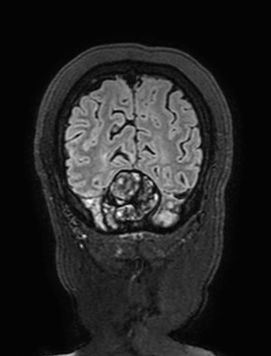 Cavernous hemangioma of the cerebellar falx (Radiopaedia 73025-83724 Coronal FLAIR 314).jpg