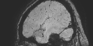 Cavernous hemangioma of the cerebellar falx (Radiopaedia 73025-83724 Sagittal BOLD 172).jpg