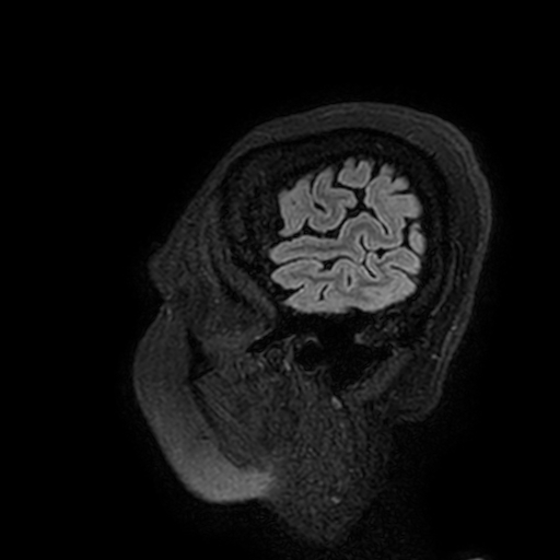 Cavernous hemangioma of the cerebellar falx (Radiopaedia 73025-83724 Sagittal FLAIR 205).jpg