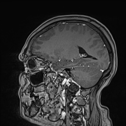 Cavernous sinus meningioma (Radiopaedia 63682-72367 Sagittal T1 C+ 112).jpg