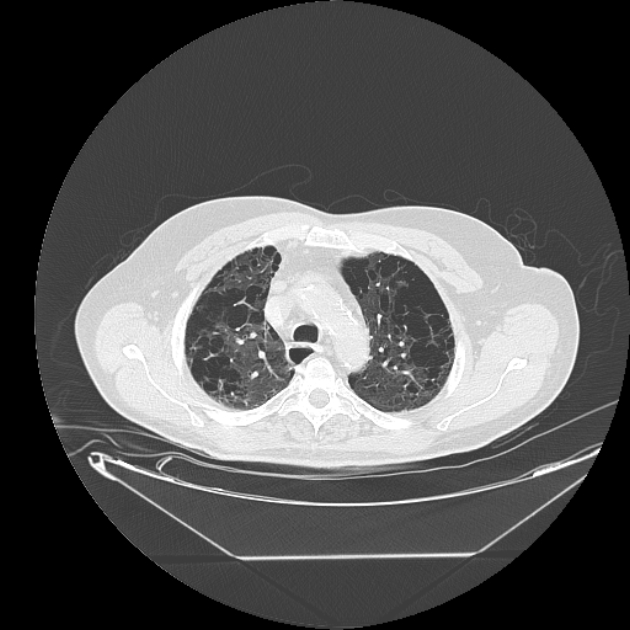 Cavitating bronchogenic carcinoma (Radiopaedia 44489-48162 Axial lung window 17).jpg