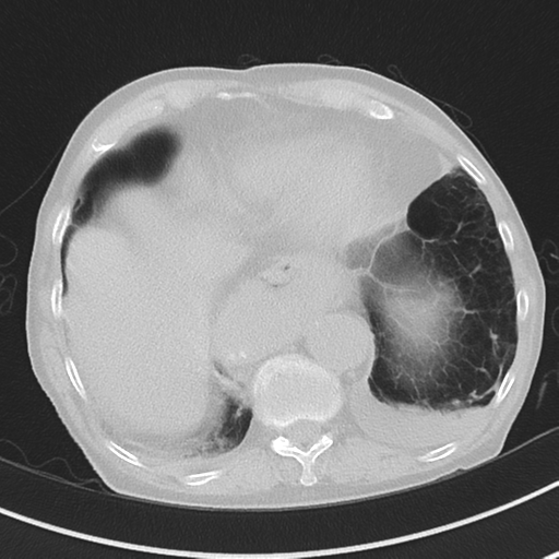 Cavitating pneumonia - lingular segments (Radiopaedia 34386-35678 Axial lung window 49).png