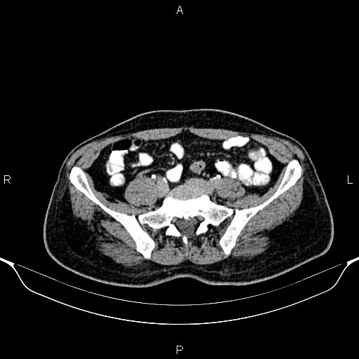 Cecal adenocarcinoma (Radiopaedia 85324-100916 Axial C+ delayed 70).jpg