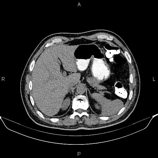 Cecal adenocarcinoma (Radiopaedia 85324-100916 Axial non-contrast 20).jpg