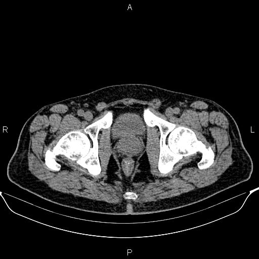 Cecal adenocarcinoma (Radiopaedia 85324-100916 Axial non-contrast 98).jpg