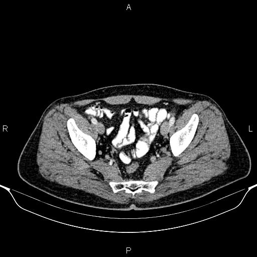 Cecal adenocarcinoma (Radiopaedia 85324-100916 B 85).jpg