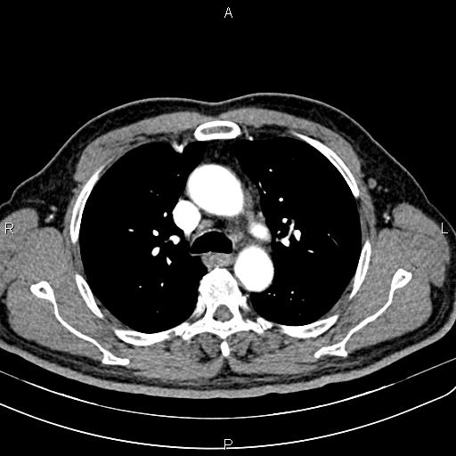 File:Cecal cancer with appendiceal mucocele (Radiopaedia 91080-108651 A 25).jpg