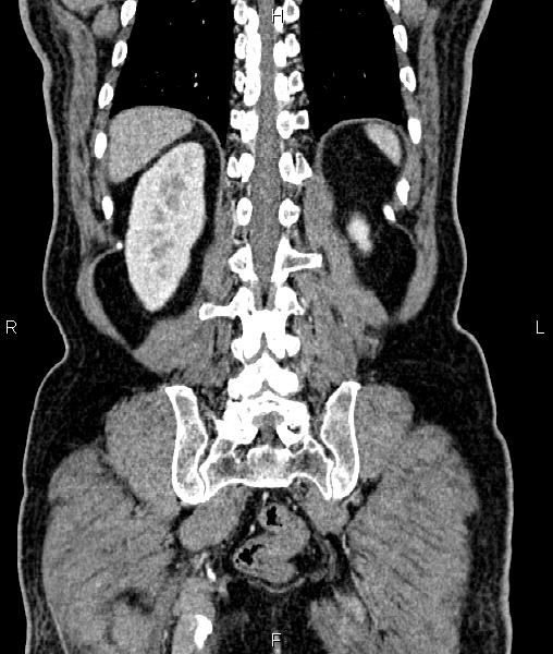 Cecal cancer with appendiceal mucocele (Radiopaedia 91080-108651 D 60).jpg