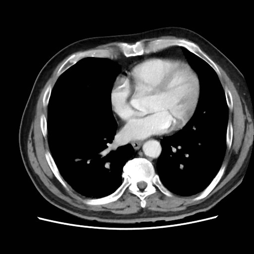 Cecal mass causing appendicitis (Radiopaedia 59207-66531 A 5).jpg