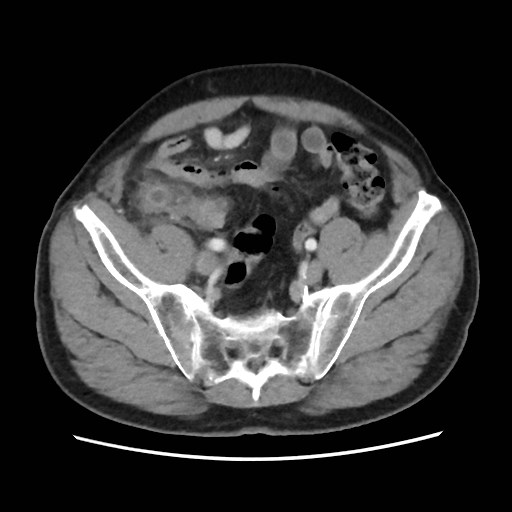 Cecal mass causing appendicitis (Radiopaedia 59207-66531 A 69).jpg